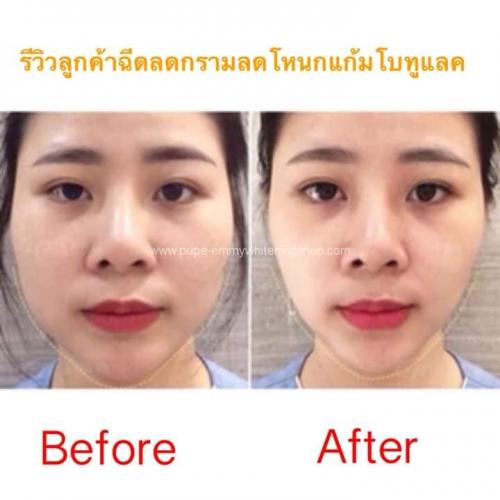 โบท็อกซ์หน้าเรียวลดกราม-ฟิลเลอร์-กลูต้าไธโอนแบบฉีด-ของแท้-ถูก